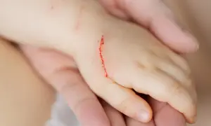 Dziecięca dłoń z czerwoną, krwawiącą raną po zadrapaniu.