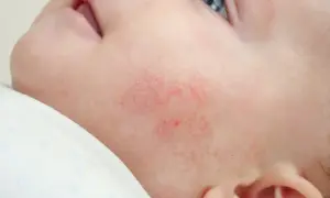 Alergia na sierść u niemowląt: Jak rozpoznać objawy i pomóc dziecku?