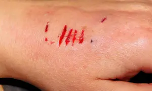 Lekkie ugryzienie przez psa szczepionego. Kilka czerwonych, płytkich zadrapań na skórze dłoni, z niewielką ilością krwi.