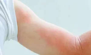 Czerwone, swędzące plamy na ramieniu, które mogą być objawem alergii na psa.