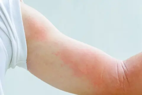 Czerwone, swędzące plamy na ramieniu, które mogą być objawem alergii na psa.