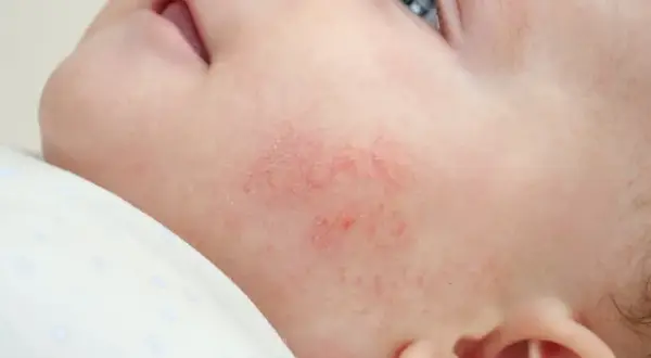 Alergia na sierść u niemowląt: Jak rozpoznać objawy i pomóc dziecku?
