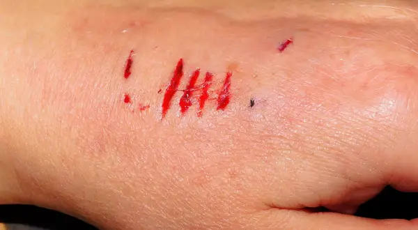 Lekkie ugryzienie przez psa szczepionego. Kilka czerwonych, płytkich zadrapań na skórze dłoni, z niewielką ilością krwi.
