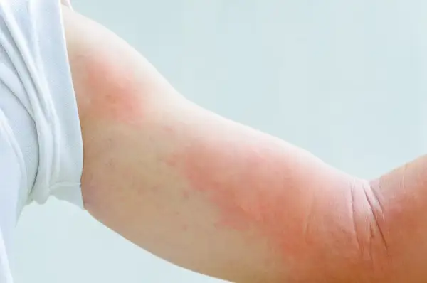 Czerwone, swędzące plamy na ramieniu, które mogą być objawem alergii na psa.